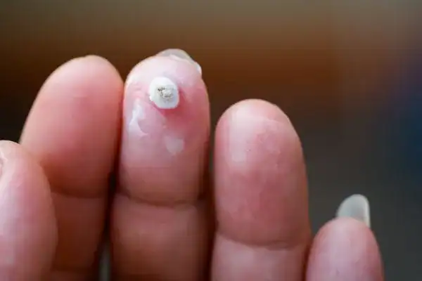 Image of white wart before cryopen treatment Redditch