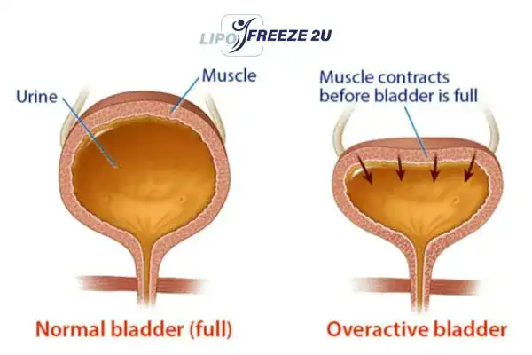 diagram of overactive bladder treatment Redditch