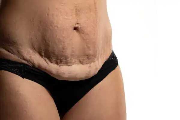 loose skin after weight loss injections Redditch