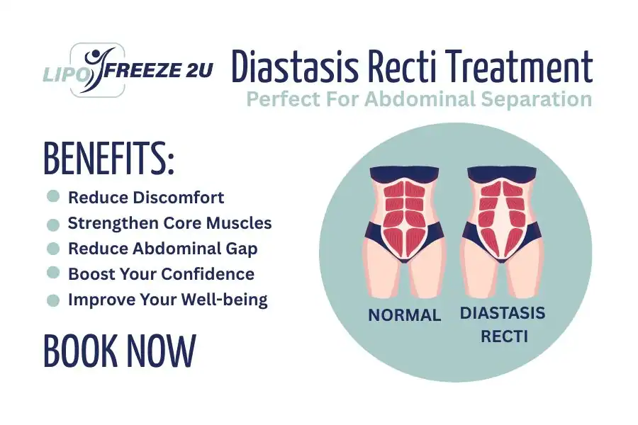 Benefits of body toning treatment Redditch for Diastasis recti
