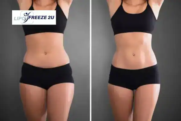 How Can LIPO FREEZE 2U Support Your Post-Pregnancy Body Recovery Redditch?