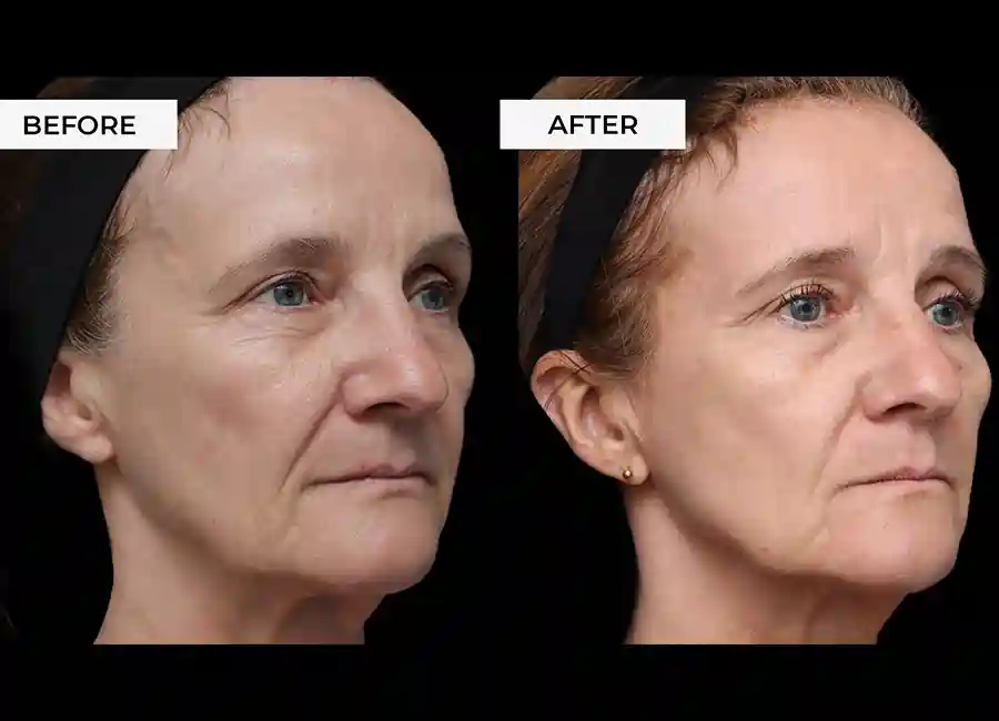 How Many RF Microneedling Sessions Will You Need to See a Difference Redditch?