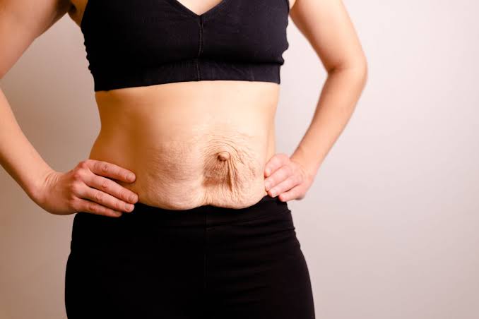 Is Surgery Really the Only Way to Repair Diastasis Recti Redditch?